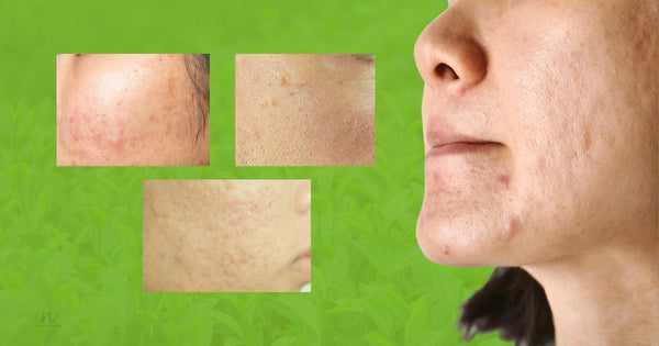 How to use tea tree oil for acne scars