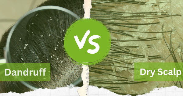 Difference Between Dandruff and Dry Scalp ?