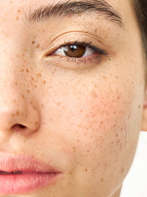 Dark spots / Pigmentation